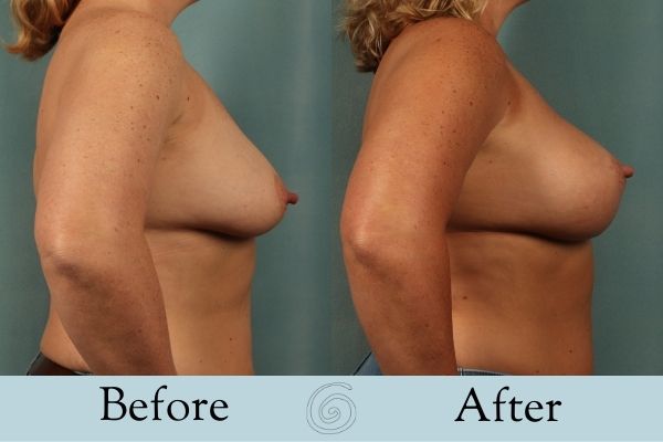 Breast Augmentation and Lift Before and After 1 _ Side