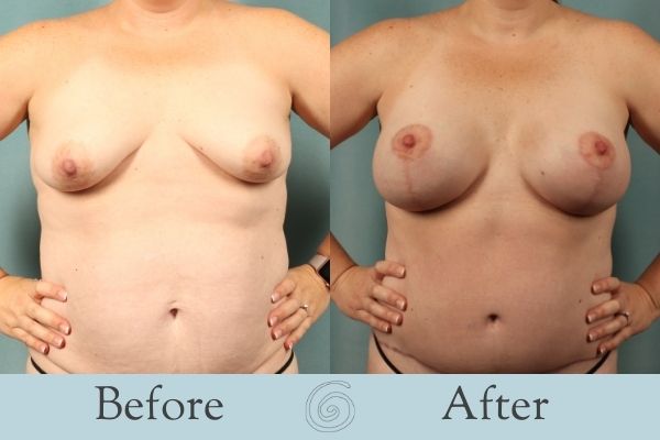 Breast Augmentation and Lift Before and After 10 - Front
