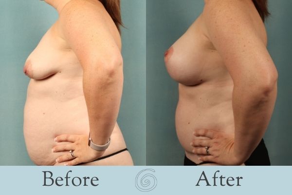 Breast Augmentation and Lift Before and After 10 - Side
