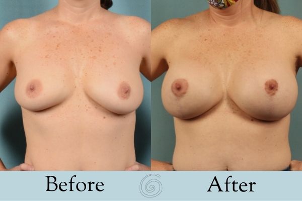 Breast Augmentation and Lift Before and After 11 _ Front