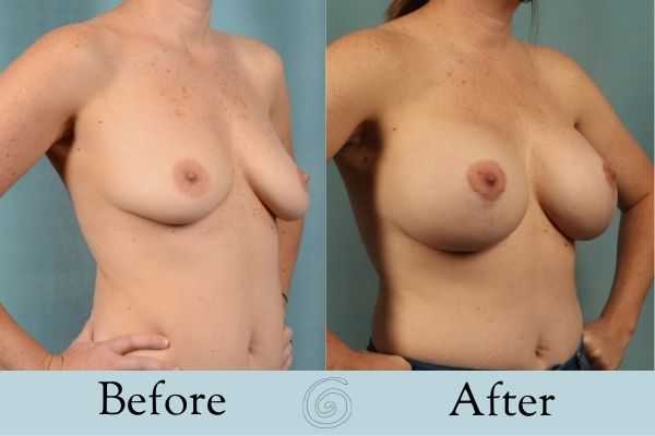 Breast Augmentation and Lift Before and After 11 _ Side