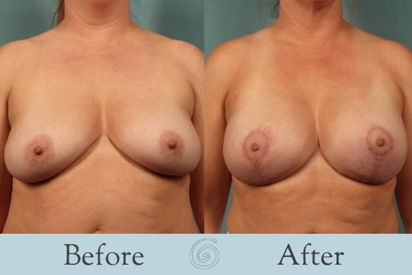 Breast Augmentation and Lift Before and After 12 _ Front