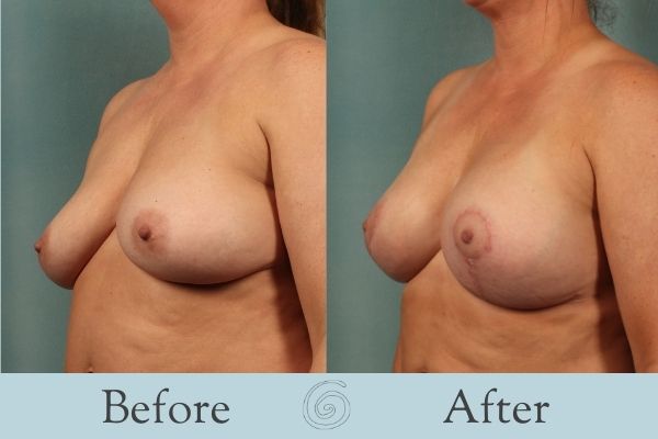 Breast Augmentation and Lift Before and After 12 _ Side