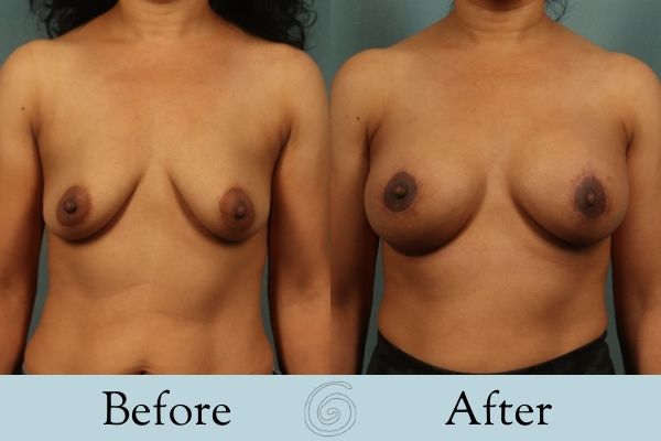 Breast Augmentation and Lift Before and After 13 _ Front