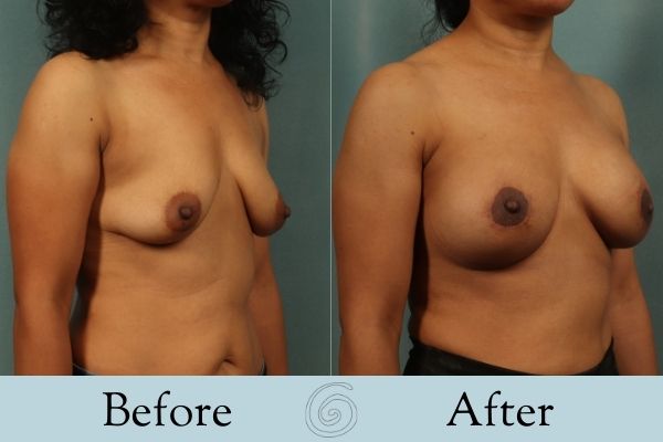 Breast Augmentation and Lift Before and After 13 _ Side