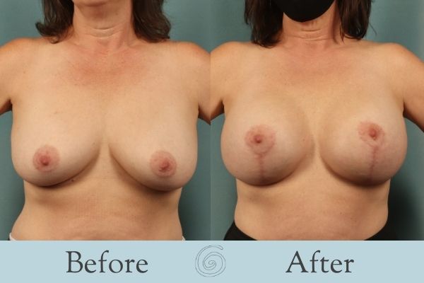 Breast Augmentation and Lift Before and After 2 _ Front