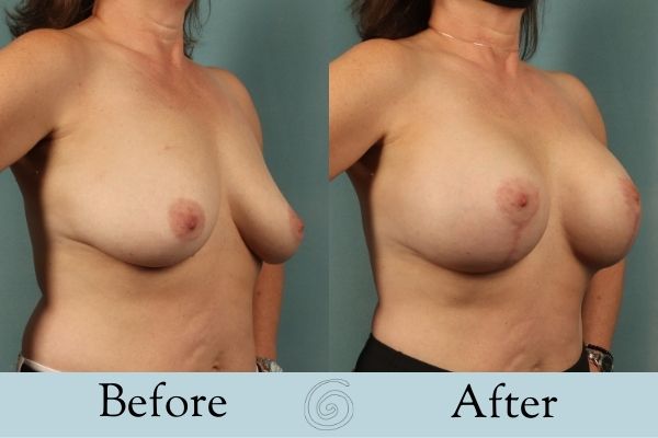 Breast Augmentation and Lift Before and After 2 _ Side