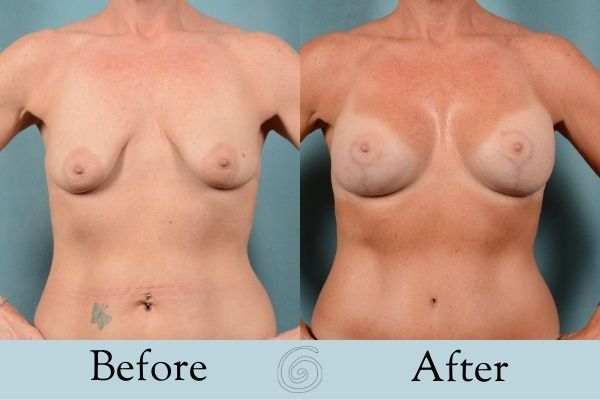 Breast Augmentation and Lift Before and After 3 _ Front