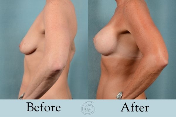 Breast Augmentation and Lift Before and After 3 _ Side