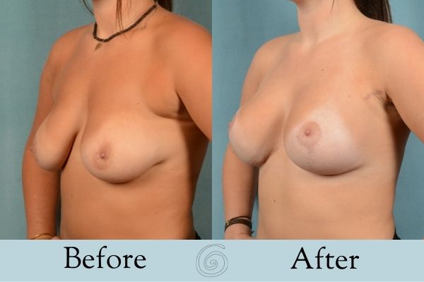 Breast Augmentation and Lift Before and After 4 _ Side