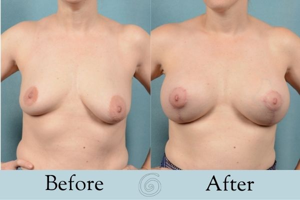 Breast Augmentation and Lift Before and After 5 _ Front