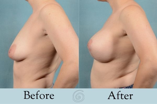 Breast Augmentation and Lift Before and After 5 _ Side