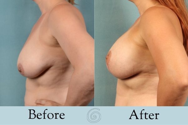 Breast Augmentation and Lift Before and After 6 _ Side