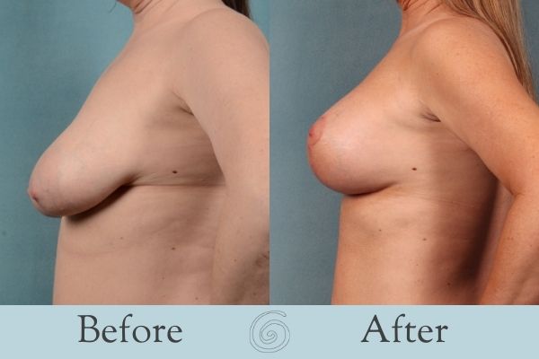Breast Augmentation and Lift Before and After 7 - Side