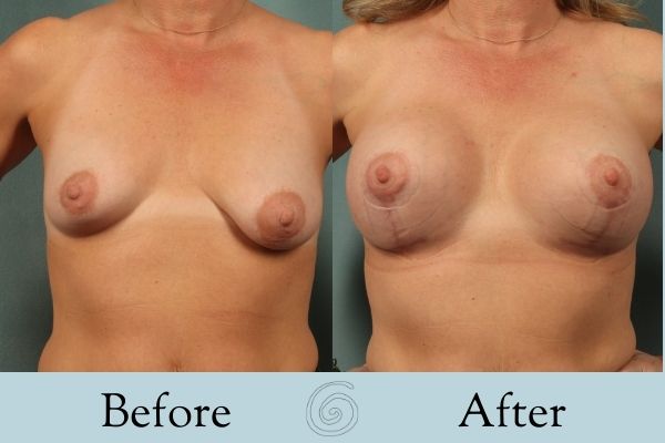 Breast Augmentation and Lift Before and After 8 - Front