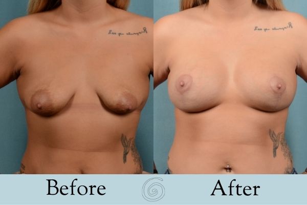 Breast Augmentation and Lift Before and After 9 _ Front