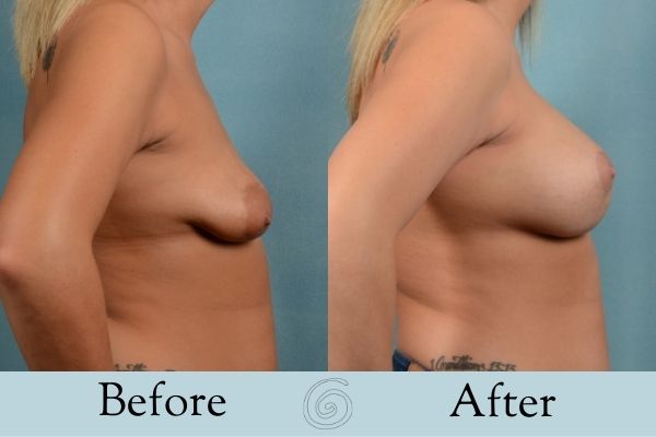 Breast Augmentation and Lift Before and After 9 _ Side