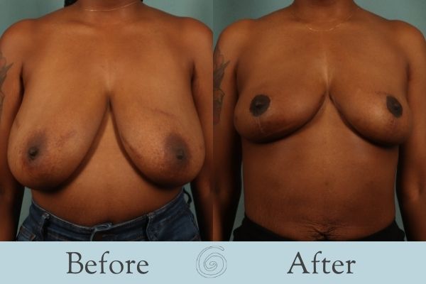 Breast Reduction Before and After 16 - Front
