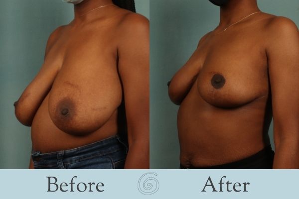 Breast Reduction Before and After 16 - Side