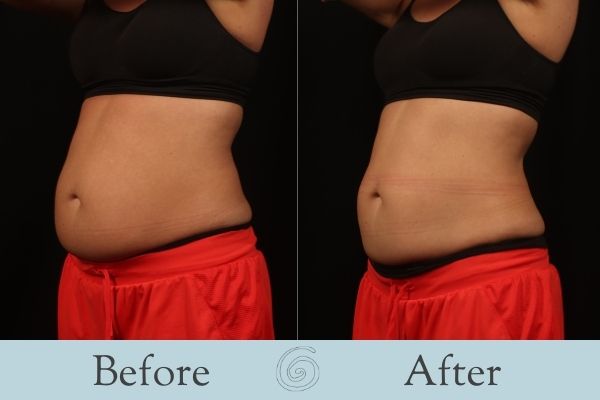 CoolSculpting Before and After 10 - Front