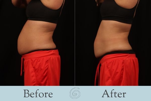 CoolSculpting Before and After 10 - Side