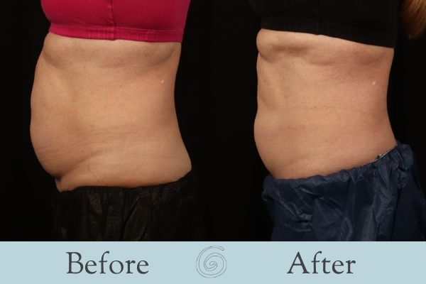 CoolSculpting Before and After 12 - Front