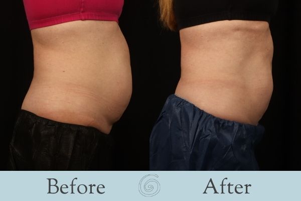 CoolSculpting Before and After 12 - Side