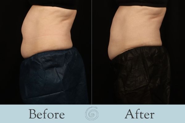CoolSculpting Before and After 8 - Side