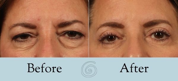 Eyelid Surgery Before and After 24 - Front