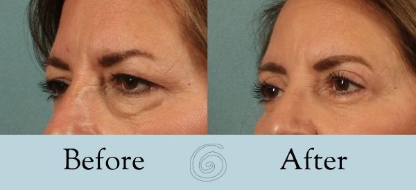Eyelid Surgery Before and After 24 - Side