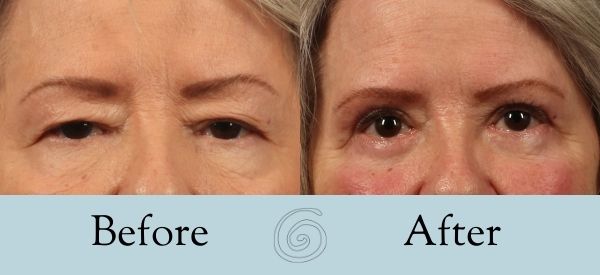 Eyelid Surgery Before and After 25 - Front