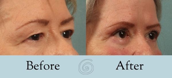 Eyelid Surgery Before and After 25 - Side