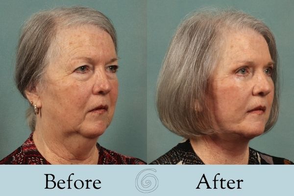 Facelift Before and After 6 - Side