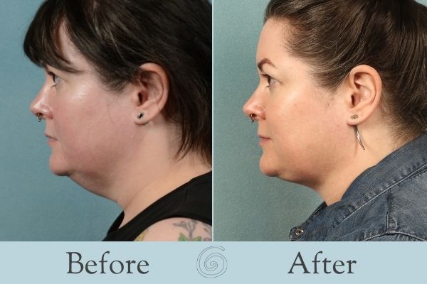 Liposuction Before and After 9 - Side