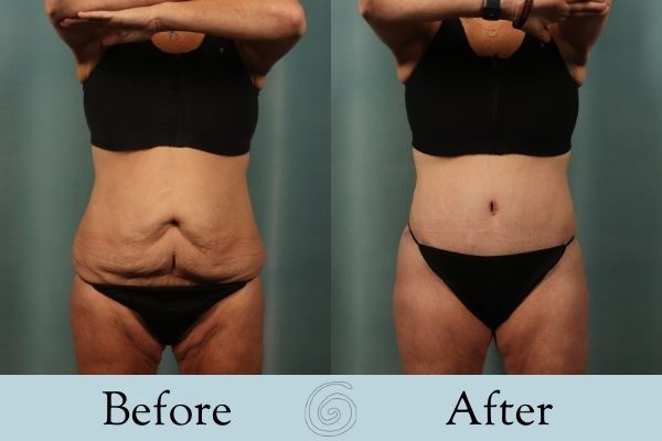 Tummy Tuck Before and After 24 - Front