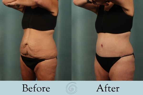 Tummy Tuck Before and After 24 - Side