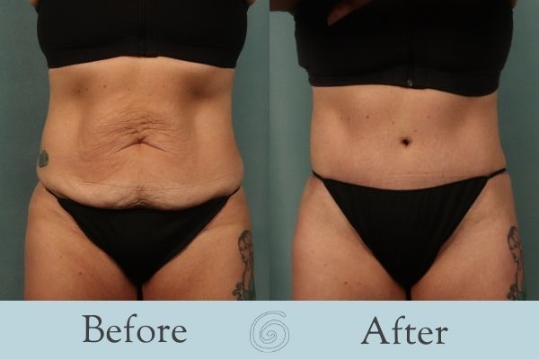 Tummy Tuck Before and After 25 - Front