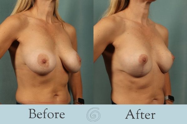 Breast Augmentation and Lift Before and After 14 _ Side