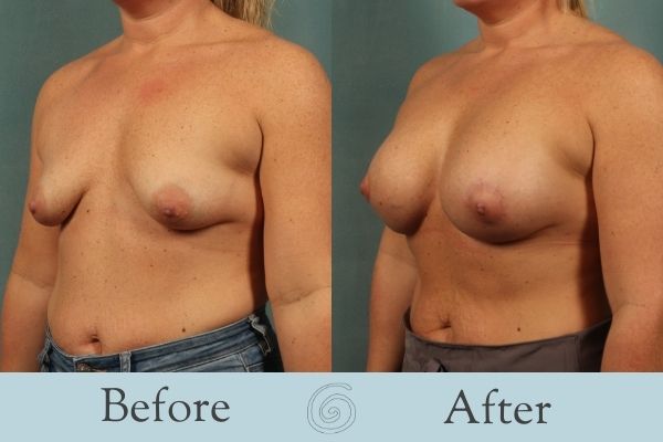 Breast Augmentation and Lift Before and After 15 _ Side