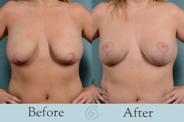 Breast Lift Before and After 4 _ Front