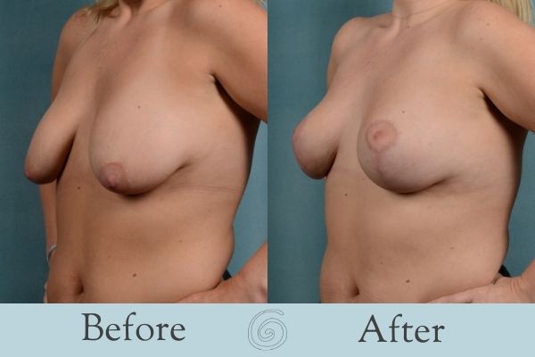 Breast Lift Before and After 4 _ Side