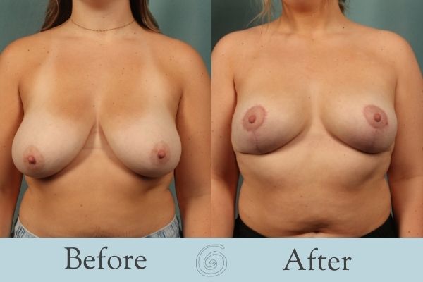 Breast Lift Before and After 5 - Front