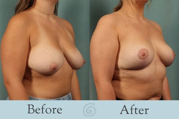 Breast Lift Before and After 5 - Side