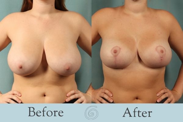 Breast Reduction Before and After 17 - Front