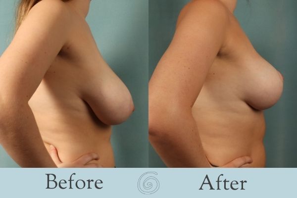 Breast Reduction Before and After 17 - Side