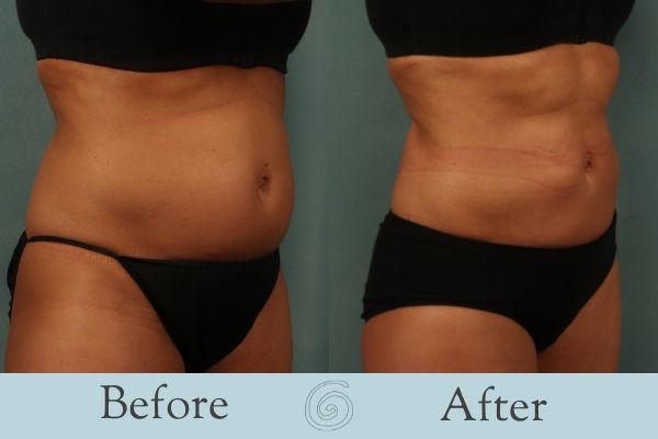 Liposuction Before and After 10 - Front