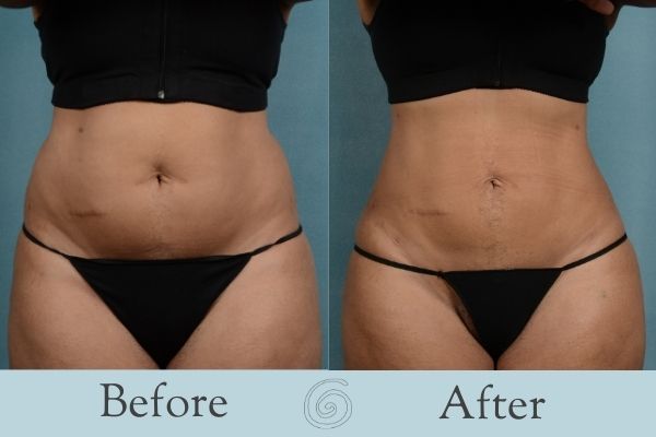 Liposuction Before and After 11 - Front