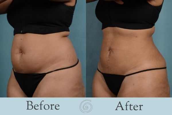 Liposuction Before and After 11 - Side