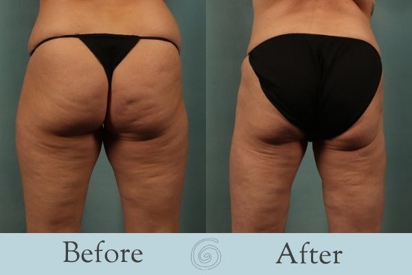 Liposuction Before and After 12 - Back