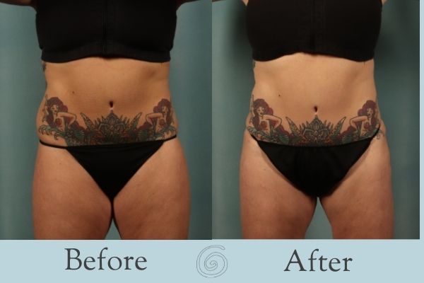 Liposuction Before and After 12 - Front
